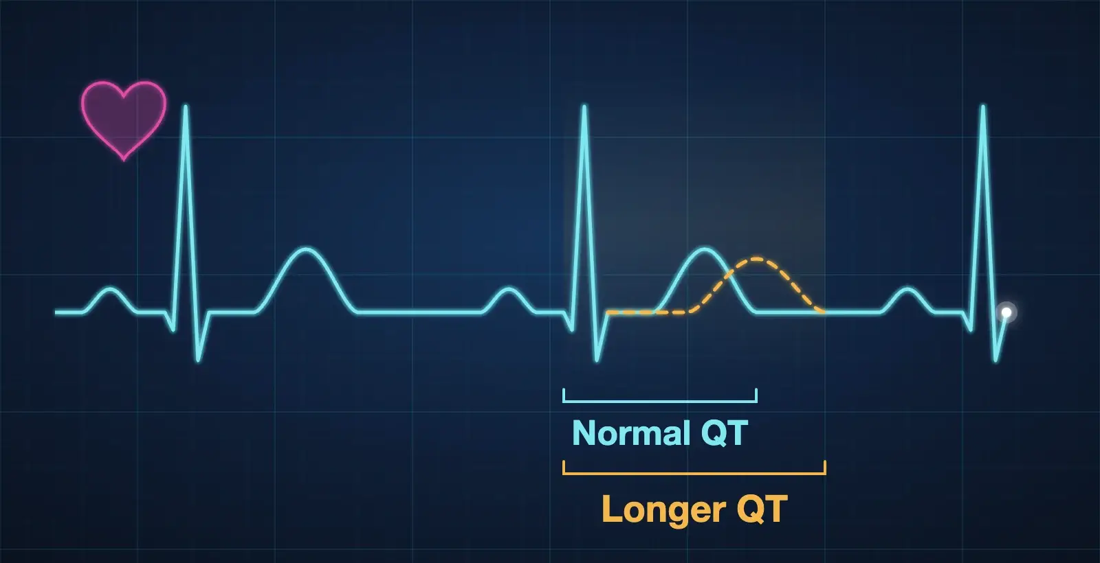 EKG illustration comparing a normal QT interval with a longer QT interval